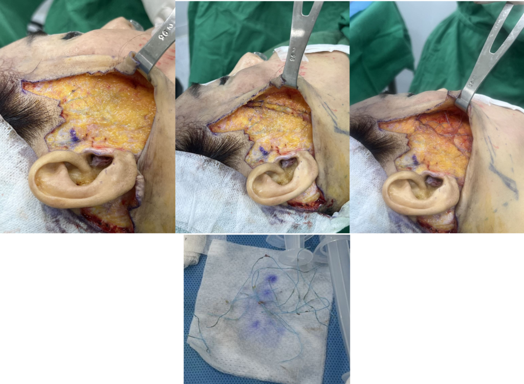 Surgical view during a deep plane facelift showing the irregular embedding of previously placed lifting threads into the SMAS layer and their subsequent removal by the surgeon.