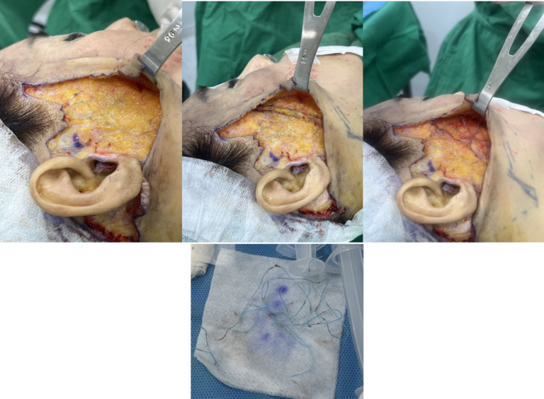 Surgical view during a deep plane facelift showing the irregular embedding of previously placed lifting threads into the SMAS layer and their subsequent removal by the surgeon.