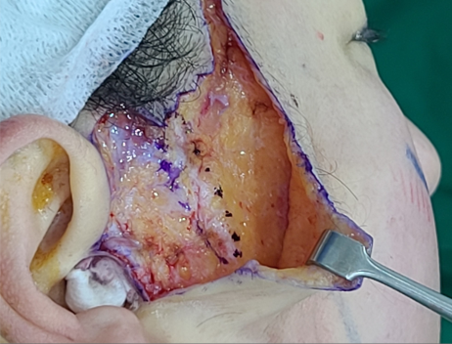 Intraoperative finding during facelift: Scar tissue at the thread insertion site following degradation.
