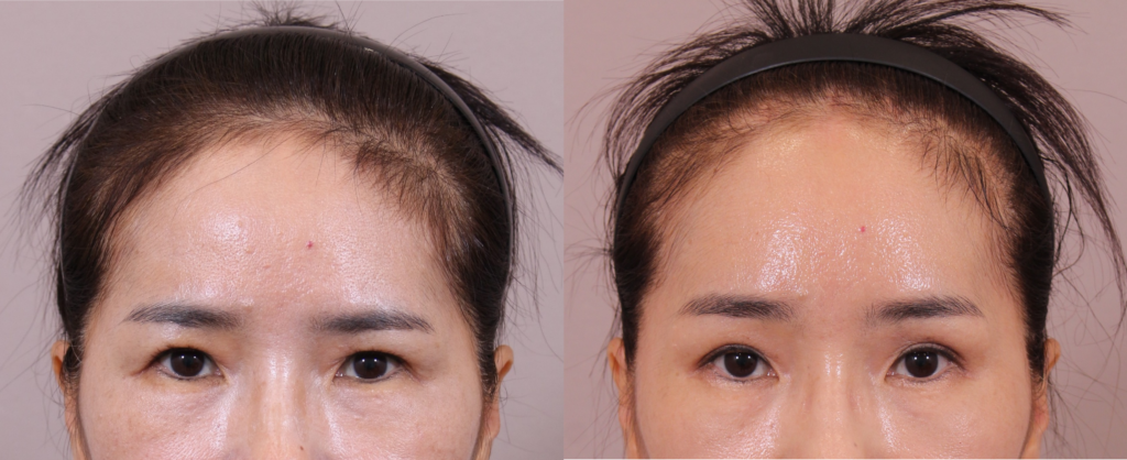 Before (Left) vs. 1 Month Post-Op (Right). Restored brow position, open eyes, and smoothed forehead wrinkles.