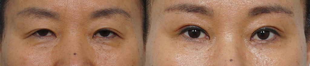 Case 4: A female patient in her 50s with thick upper facial tissue presented with severe brow ptosis, significant eyelid hooding, and weak levator function. Because heavy forehead compensation indicated that traditional upper blepharoplasty alone would worsen the brow descent, an endoscopic forehead lift was performed. Concurrently, sub-brow excision addressed the severe skin laxity, and incisional ptosis correction was performed to achieve clear, bright, and natural-looking eyes.

Left: Pre-op / Right: 1 Month Post-op