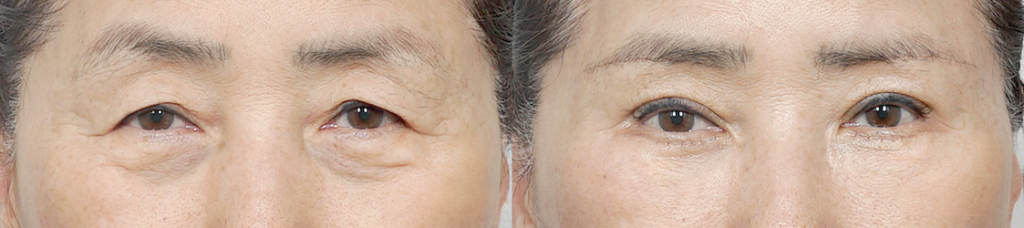 Case 1: A female patient in her 60s presented with severe upper eyelid laxity. To achieve a soft and natural outcome, a combined sub-brow lift and upper blepharoplasty was performed.
Left: Pre-op / Right: 1 Week Post-op