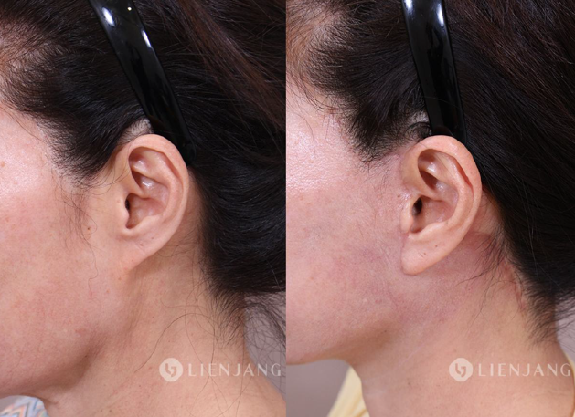 Facelift Scars Healing Timeline & Care Guide: From Day 1 to 1-Year Post-Op