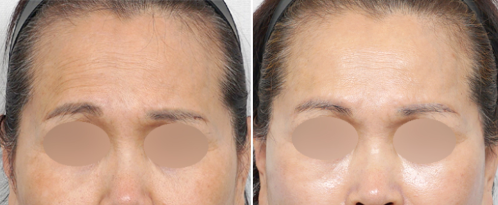 Case 5: A female patient in her 60s presented with severe brow ptosis and noticeable asymmetry. Due to her broad forehead, she opted against an endoscopic forehead lift; therefore, a direct brow lift was performed. Following the surgery, the brow descent and asymmetry were successfully corrected, alongside an improvement in forehead wrinkles. Pre-op vs. 1Mo Post-op. Left: Pre-operative | Right: Restored brow position and refreshed eye area.