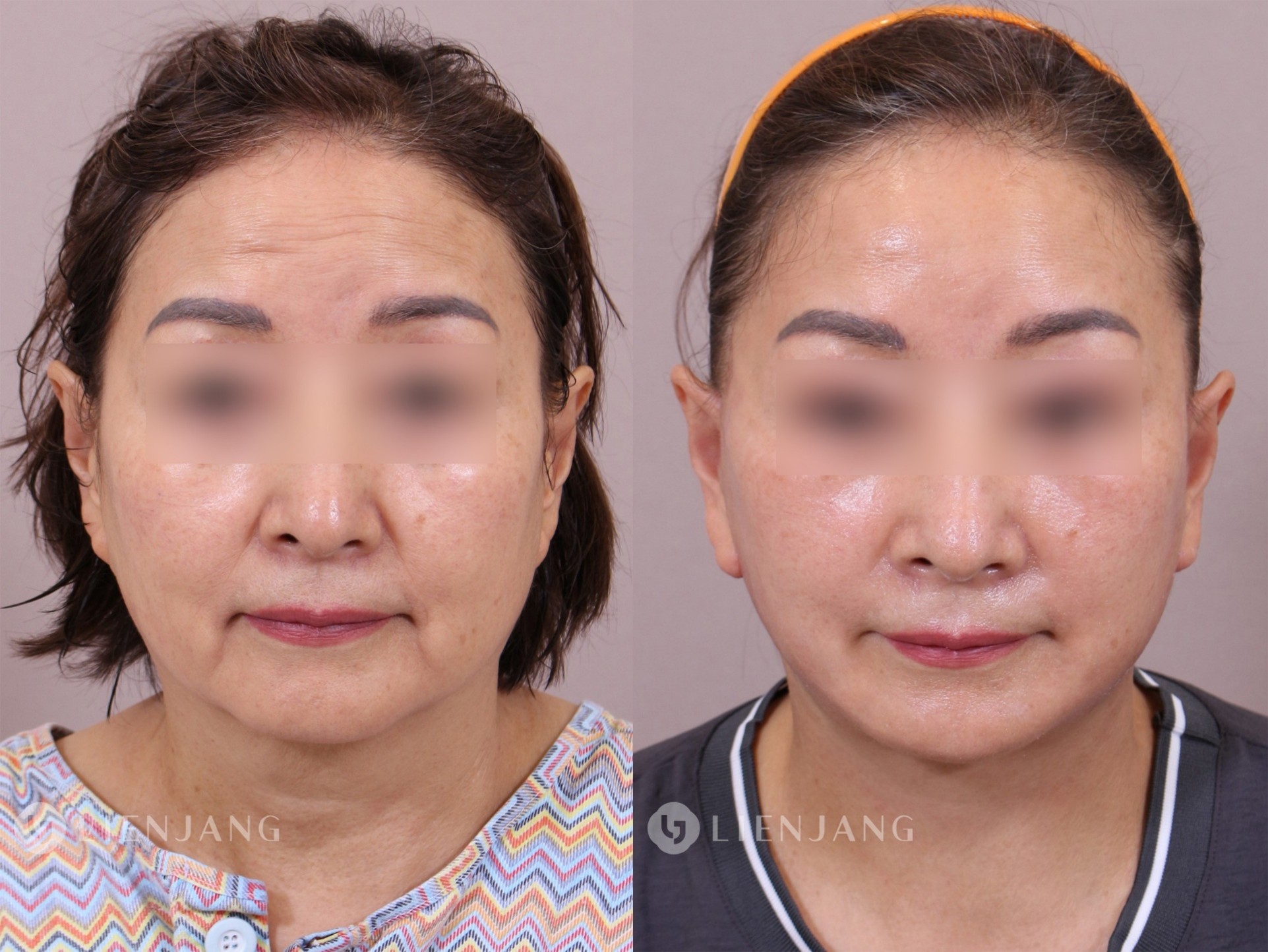 Before and after comparison of a patient one month after a face and neck lift. The left image shows the pre-operative state with visible sagging in the lower face and neck. The right image shows the state one month post-operative, with significant improvement in skin tightness and reduction of sagging.