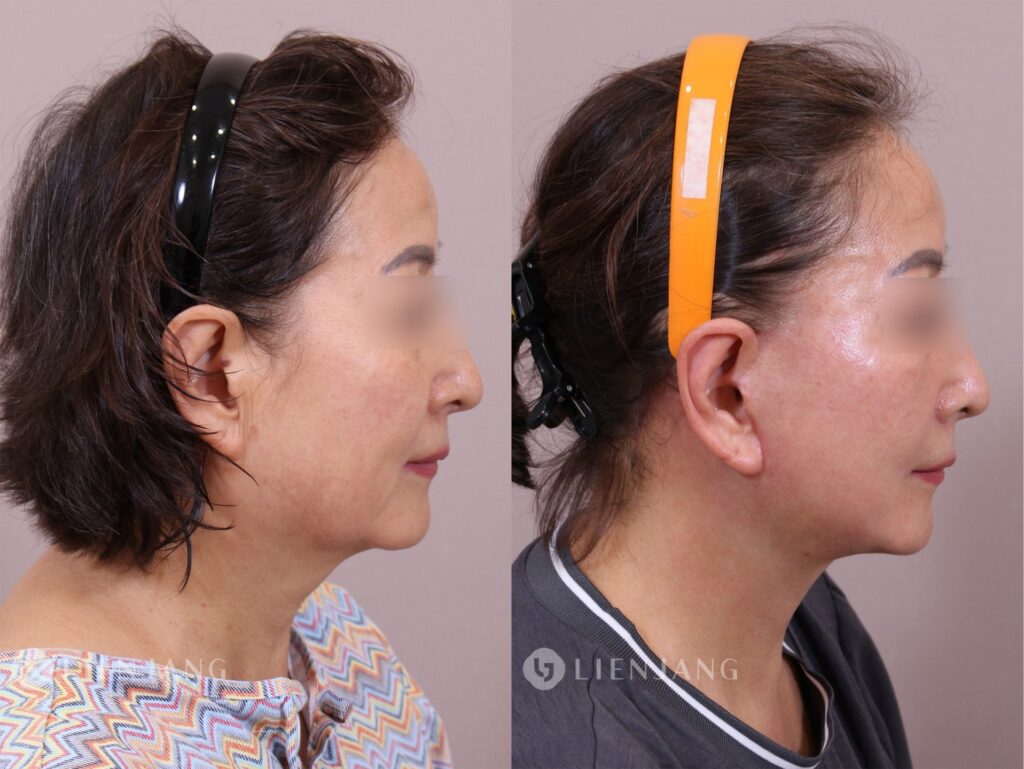 Before and after comparison of a patient one month after a face and neck lift. The left image shows the pre-operative state with visible sagging in the lower face and neck. The right image shows the state one month post-operative, with significant improvement in skin tightness and reduction of sagging.