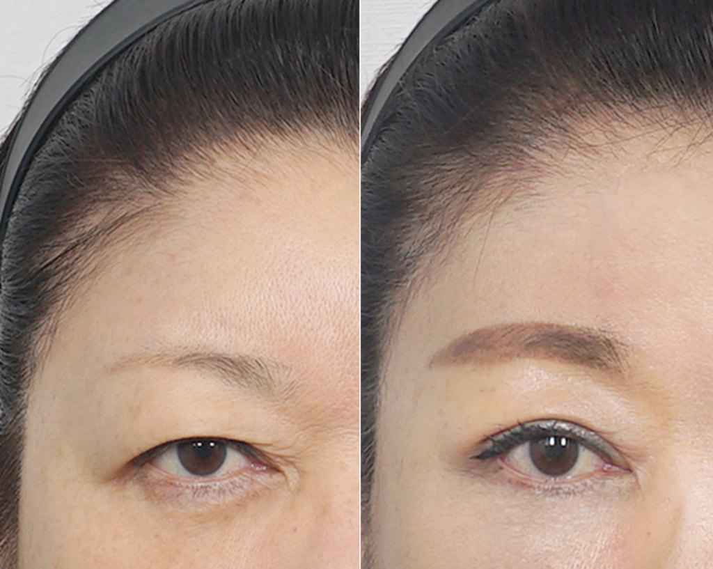Case 3: A female patient in her 50s with thick upper facial tissue presented with severe brow ptosis, significant eyelid hooding, and weak levator function. Because heavy forehead compensation indicated that traditional upper blepharoplasty alone would worsen the brow descent, an endoscopic forehead lift was performed. Concurrently, sub-brow excision addressed the severe skin laxity, and incisional ptosis correction was performed to achieve clear, bright, and natural-looking eyes.

Left: Pre-op / Right: 1 Month Post-op