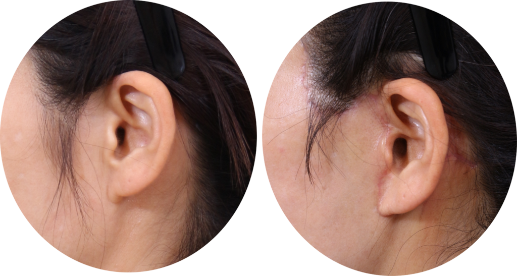 Week 2 Post-Operative Stage: Surface puncture marks and acute ecchymosis (bruising) have fully cleared. The incision line remains secure, and silicone-based scar management can safely begin.