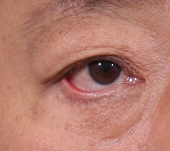 Lower Blepharoplasty Complications: Ectropion