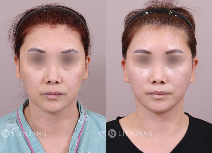 Before and after comparison of an endoscopic mini facelift. The left image shows early jowling and mid-face sagging. The right image shows a restored mid-face volume and sharp jawline contour.