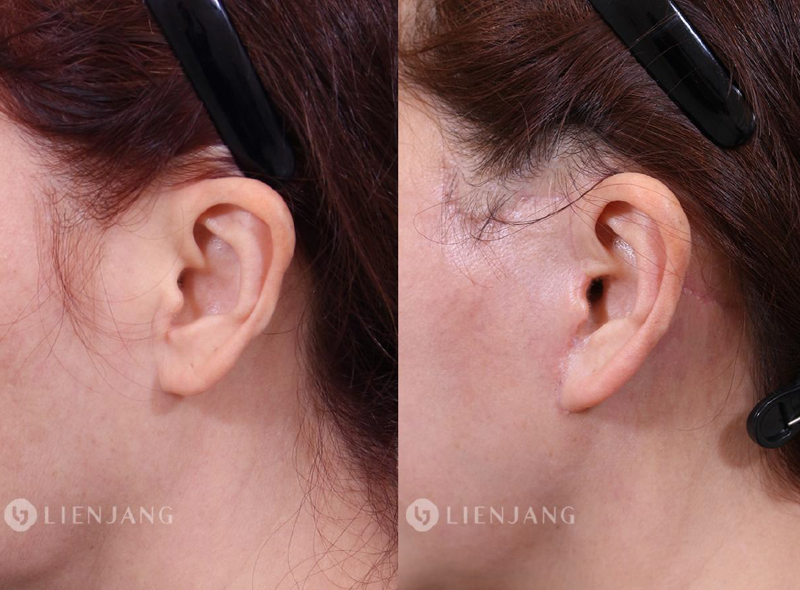 Month 3 Post-Operative Stage: The scar has fully entered the maturation phase. Collagen fibers have reorganized, resulting in a flat, pliable scar that closely matches natural skin color and anatomical contours.