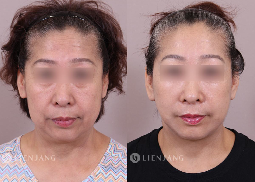 Before and after comparison of a patient one month after a face and neck lift. The left image shows the pre-operative state with visible sagging in the lower face and neck. The right image shows the state one month post-operative, with significant improvement in skin tightness and reduction of sagging.