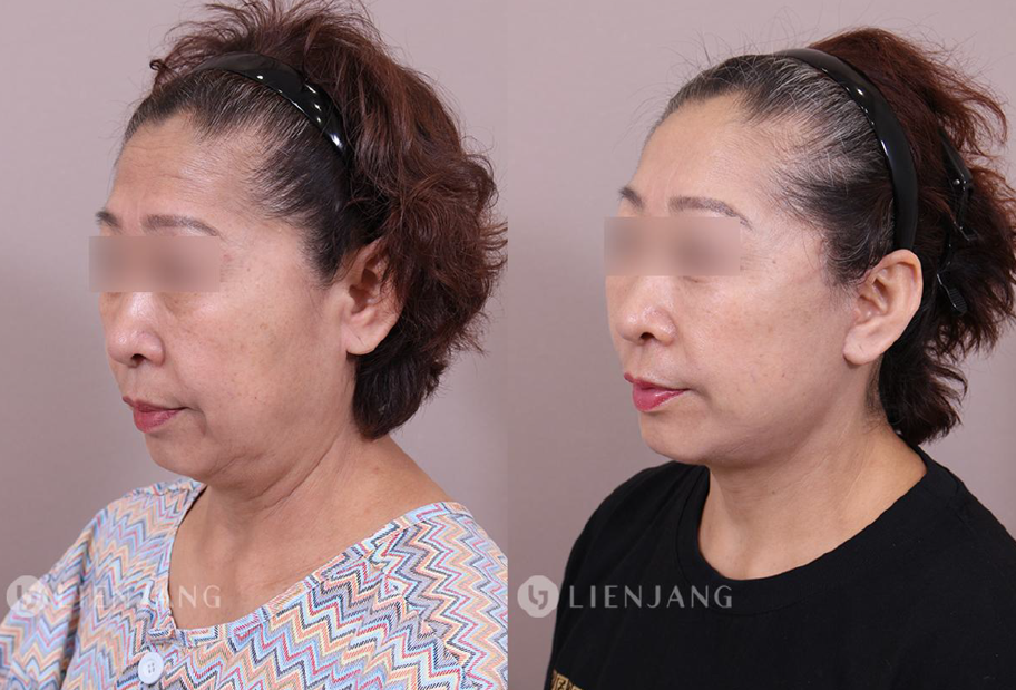 Before and after comparison of a patient one month after a face and neck lift. The left image shows the pre-operative state with visible sagging in the lower face and neck. The right image shows the state one month post-operative, with significant improvement in skin tightness and reduction of sagging.