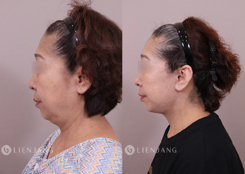 Before and after comparison of a patient one month after a face and neck lift. The left image shows the pre-operative state with visible sagging in the lower face and neck. The right image shows the state one month post-operative, with significant improvement in skin tightness and reduction of sagging.