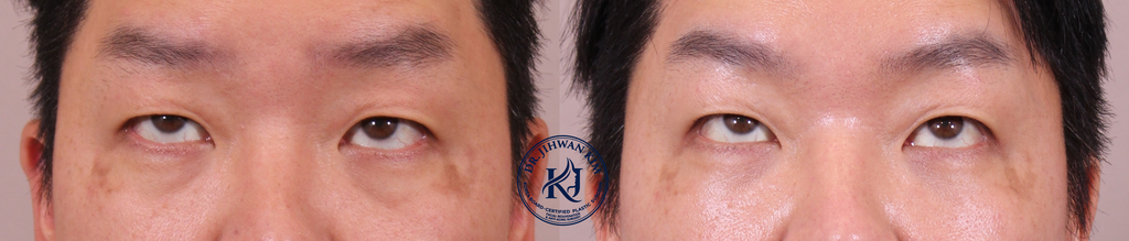 Under-Eye Fat Repositioning Before and After 1 Month Result