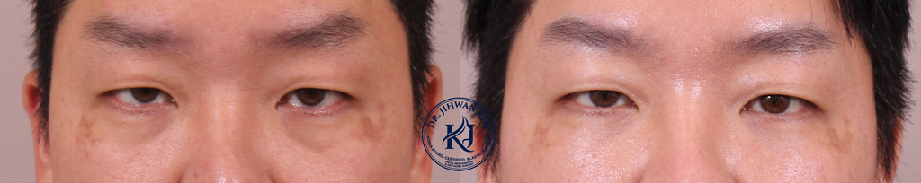 Before and 1 month after comparison: Under-Eye Fat Repositioning showing smooth under-eye contours and reduced bags.