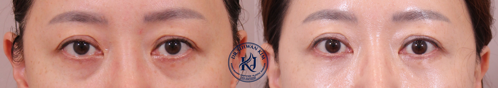 Before and 1 month after comparison: Under-Eye Fat Repositioning showing smooth under-eye contours and reduced bags.