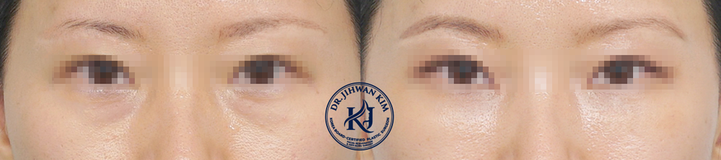 Transconjunctival Fat Repositioning + Micro-Autologous Fat Grafting
Orbital fat was smoothly repositioned through an internal conjunctival incision, while micro-autologous fat grafting was additionally performed to address the generalized volume deficiency spanning from the under-eye to the anterior cheek (midface) area.