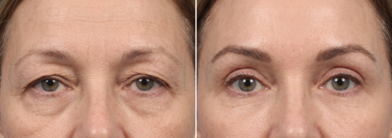 Why Upper Blepharoplasty Can Look Unnatural: The Eye-Brow-Forehead Connection