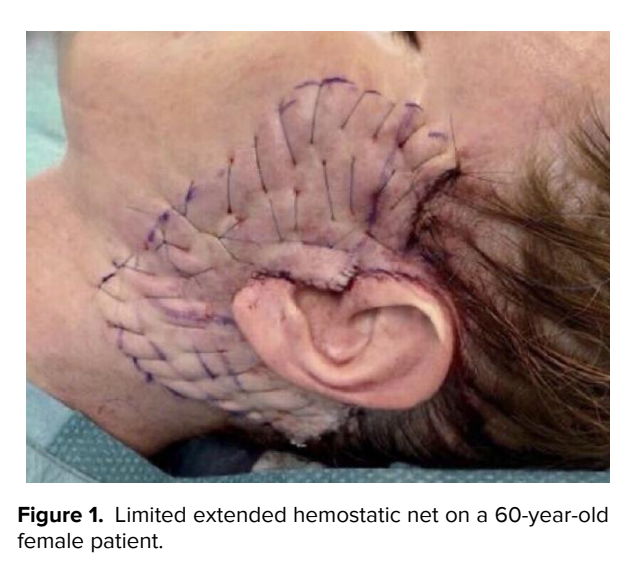 Janssen TJ, Maheshwari K, Sivadasan A, Waterhouse N. Hemostatic Net in Facelift Surgery: A 5-Year Single-Surgeon Experience. Aesthetic Surg J. 2023;43(10):1106–1111. doi:10.1093/asj/sjad097