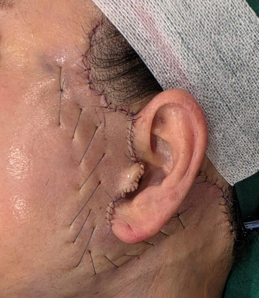 Immediate Post-Operative State: The incision is meticulously sutured along the natural preauricular crease and hairline. A specialized hemostatic net is applied across the flap to suppress early bleeding, dead space, and acute bruising.