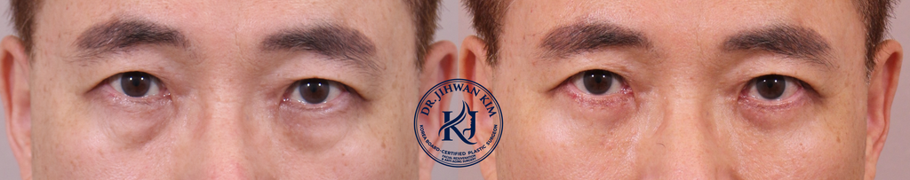 Lower Blepharoplasty Before and After 1 Month Result