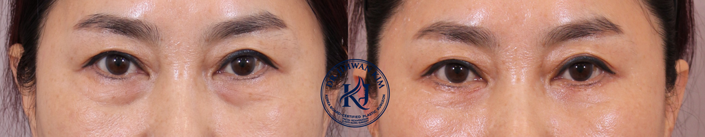 Lower Blepharoplasty Before and After 1 Month Result