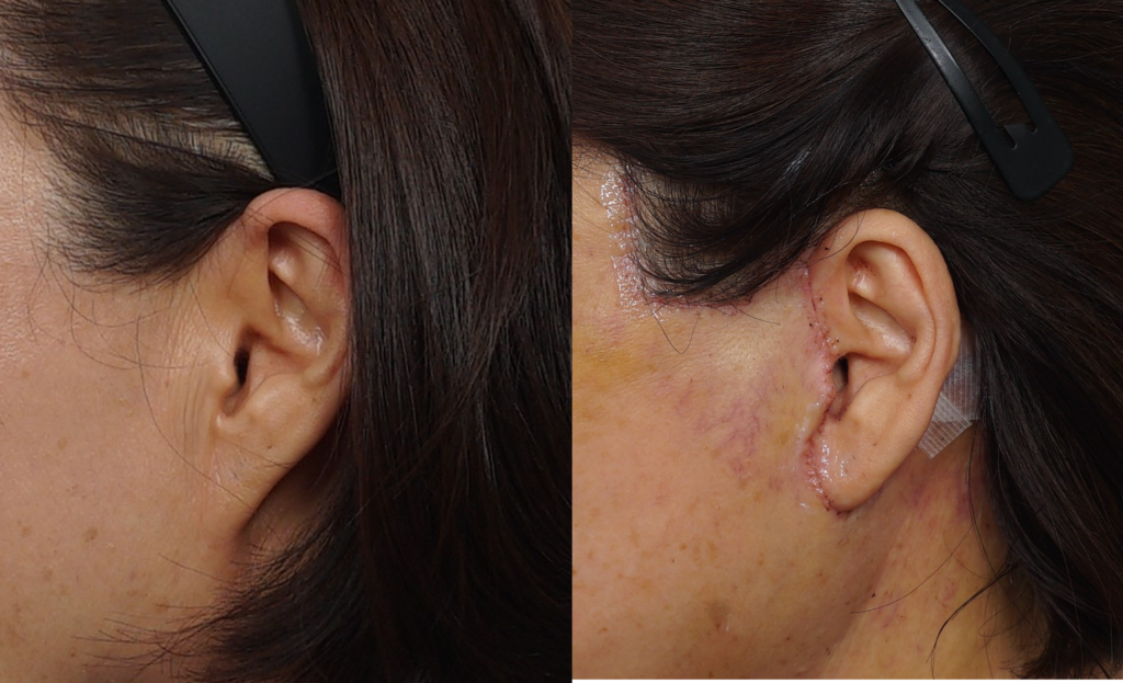 Facelift scar immediately after suture removal 