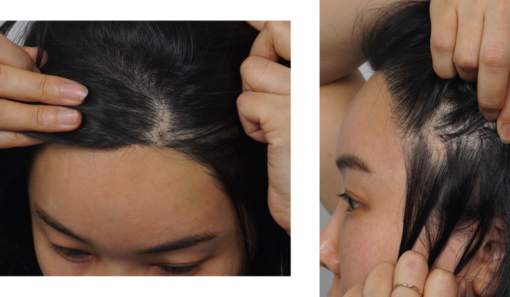 Endoscopic Forehead Lift Incisions: 2 Weeks Post-Op Healing Status.