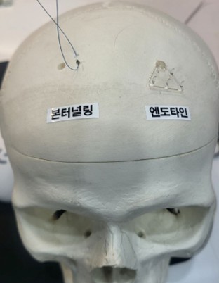 Comprehensive Guide to Endoscopic Forehead Lift: Incisions, Dissection, Fixation, and Before & Afters