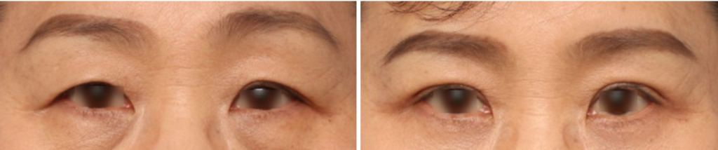 Comparison photos before and after upper blepharoplasty.Left (Before): The eyebrows are held high due to the compensatory action of the forehead muscles for sagging skin.Right (After): The surgery was successful, with the double eyelids more exposed and eye opening being easier. However, as the forehead muscles relaxed, the eyebrows dropped to their original position, narrowing the distance between the eyebrows and the double eyelids. The impression has become slightly harsher, and satisfaction is low.