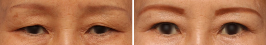 oss of Forehead Compensation and Upper Eyelid Fullness: Once eyelid laxity is excised, the frontalis muscle relaxes and the eyebrows drop to their anatomical baseline. This descent compresses the upper eyelid tissues, leading to noticeable puffiness and thickness along the fold.