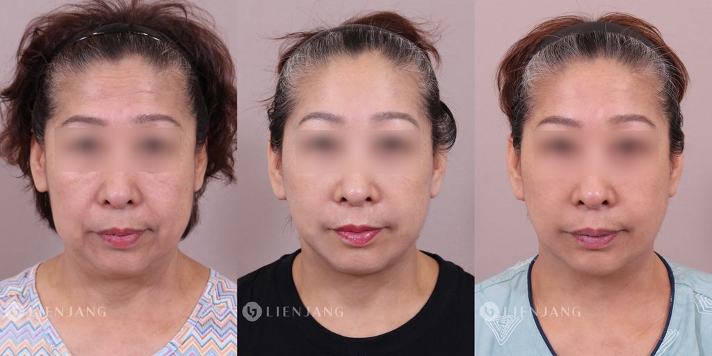 Frontal progression of the patient (displayed from left to right: pre-operative, 1 month post-op, and 3 months post-op), illustrating the gradual smoothing of forehead and glabellar lines, recovery of facial symmetry, and progressive refinement of the lower facial contour into a natural, balanced appearance.