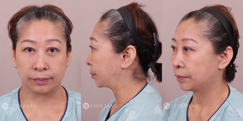 Final results at 3 months post-operation (Endoscopic forehead lift, Upper & Lower blepharoplasty, Deep plane facelift, Ant. & Lat. Necklift.) (displayed from left to right: frontal, profile, and 45-degree views), demonstrating restored facial symmetry, a smooth midfacial S-line contour, a sharply defined cervico-mental angle, and natural rejuvenation without a surgically altered appearance.