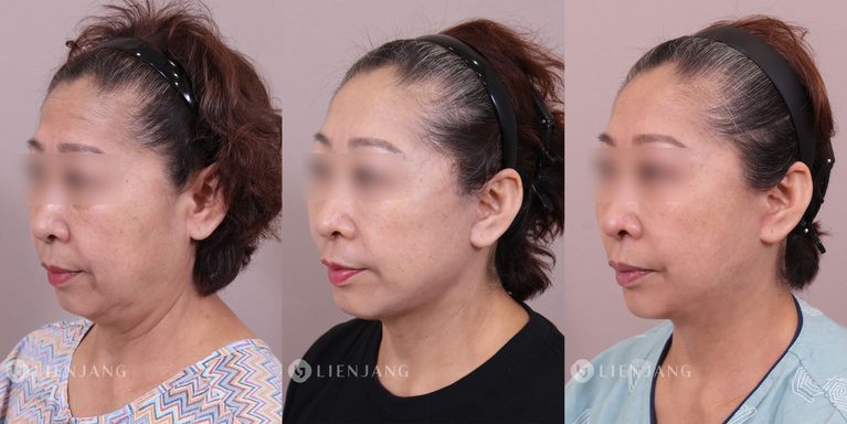 Comprehensive Anti-Aging Case Study: Deep Plane Facelift, Endoscopic Forehead Lift, and Blepharoplasty in a 60-Year-Old Patient