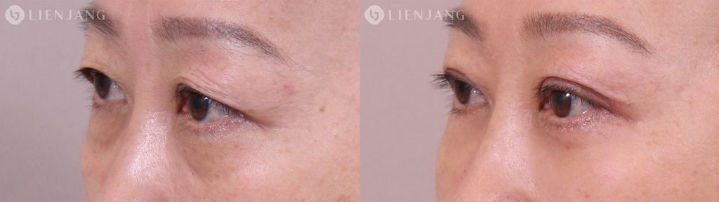 45-degree comparison of the periocular region (pre-operative vs. 3 months post-op), illustrating the smooth transition of the upper eyelid crease and the harmonious integration of the periorbital contours with the midface without an artificial or tight look.