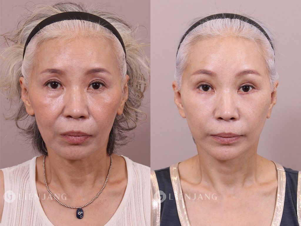 Before and after comparison of a patient one month after a face and neck lift. The left image shows the pre-operative state with visible sagging in the lower face and neck. The right image shows the state one month post-operative, with significant improvement in skin tightness and reduction of sagging.