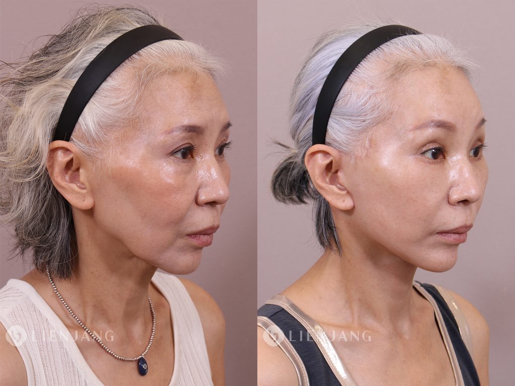 Before and after comparison of a patient one month after a face and neck lift. The left image shows the pre-operative state with visible sagging in the lower face and neck. The right image shows the state one month post-operative, with significant improvement in skin tightness and reduction of sagging.