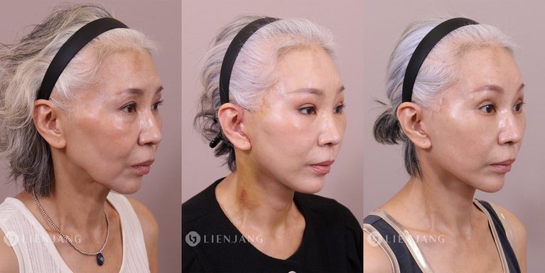 [Case Review] Total Anti-Aging in a Patient in Her 60s: From Endoscopic Forehead Lift to Deep Plane Facelift and Deep Neck Lift