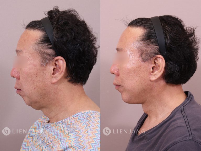 [Case Review] Deep Plane Facelift and Advanced Neck Lift for a 60-Year-Old Male: Restoring a Defined Jawline and Youthful Contour
