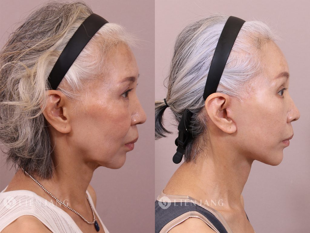 Before and after comparison of a patient one month after a face and neck lift. The left image shows the pre-operative state with visible sagging in the lower face and neck. The right image shows the state one month post-operative, with significant improvement in skin tightness and reduction of sagging.